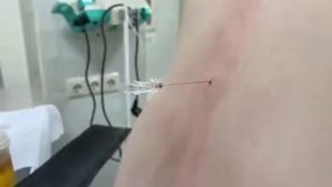 Спинальная анестезия