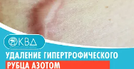 ✅ Удаление гипертрофического рубца азотом. Клинический случай №691