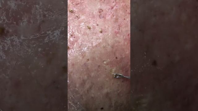 Чистка спины механическая! Удаляли чёрные точки и Комедоны на теле в течение 2 часов.