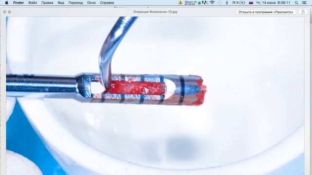 Вэбинар 3 Индивидуальные костные блоки RBB 3 смотреть онлайн