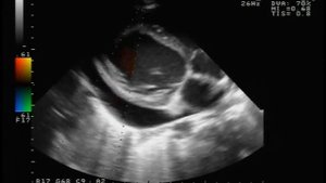 Тампонада сердца (Cardiac tamponade disease).