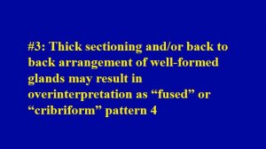 Common pitfalls that result in overgrading of prostate cancer Gleason pattern 3 as 4