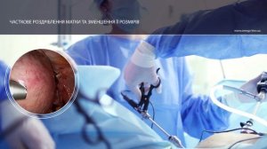 Лапароскопическое удаление матки больших размеров