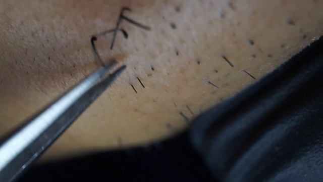 Пинцетом для удаления вросшей бородыFull HD 2020/11/22 смотреть онлайн