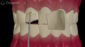Виниры для зубов: как проходит установка?