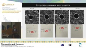 Перфузия радужной оболочки после селективной лазерной трабекулопластики: данные ОКТА