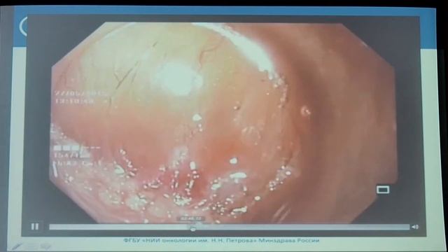 15 Ткаченко ОБ Возможности эндоскопии при удалении новообразований желудка связанных с мышечным сло смотреть онлайн