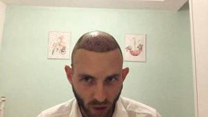 Третий день после пересадки волос