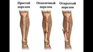 ТОП 5 переломов