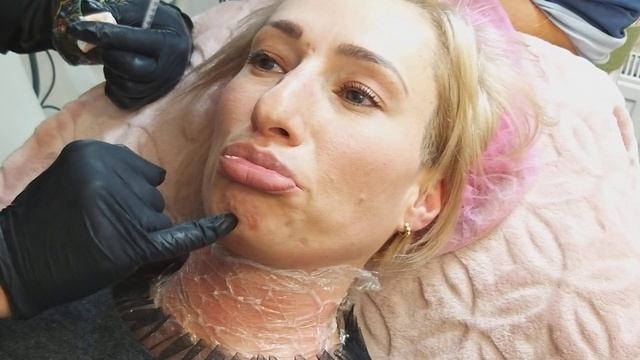 Mentalis muscle(фрагмент) смотреть онлайн