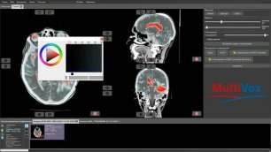 Программа для наложения 3D изображений, полученных у одного пациента (АРМ "Гамма Мультивокс Д2")