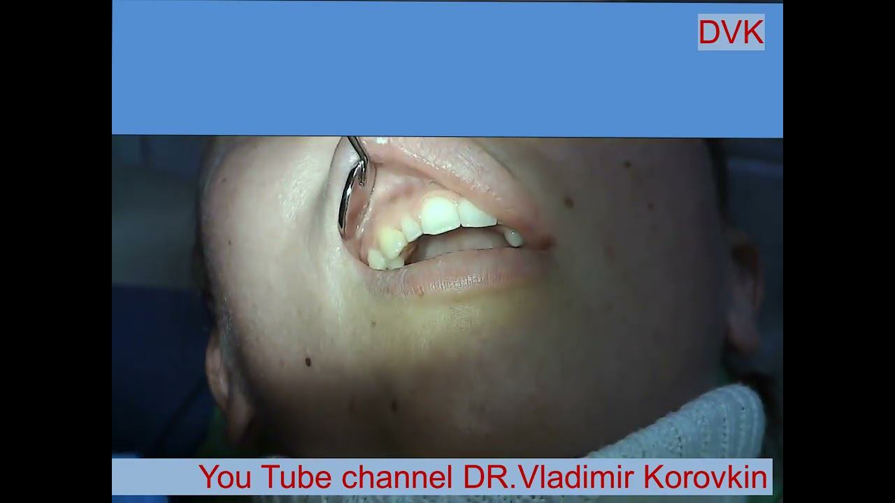 Infiltration Anesthesia for treatment 12 tooth.