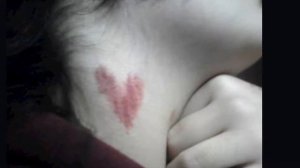 Любовная метка 6 способов избавиться от засоса очень быстро