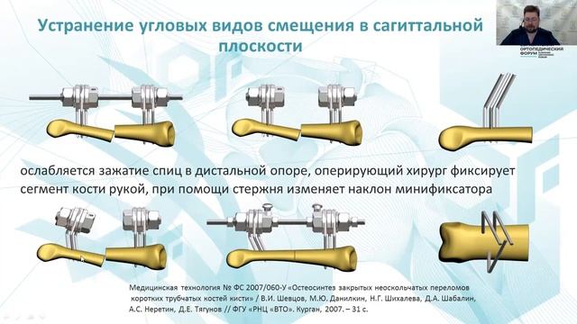 Лечение закрытых переломов коротких трубчатых костей кисти с применение мини аппарата Илизарова. смотреть онлайн