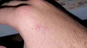 Заживление раны кожи