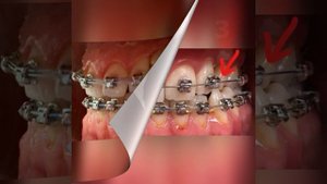 Брекеты до и после