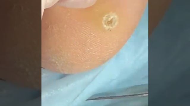 Стержневая мозоль ,удаление смотреть онлайн