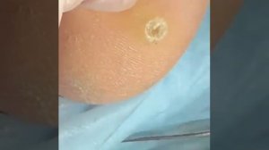 Стержневая мозоль ,удаление