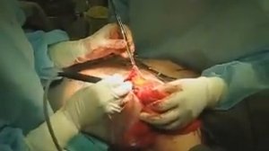 Мастопексия, удаление фиброаденомы 03