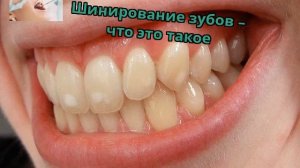 Шинирование зубов – что это такое