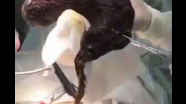 Гигантский комок волос достали из желудка 12-летней челябинки смотреть онлайн