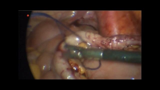 Лапароскопическая аппендэктомия | Laparoscopic Appendectomy