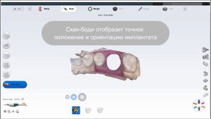 Сканирование scan body в Planmeca Romexis PlanCAD Easy