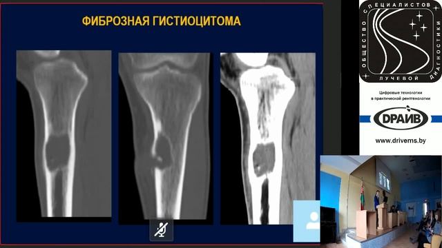 Дифференциальная диагностика злокачественных опухолей костей: доброкачественные образования смотреть онлайн