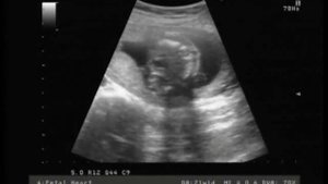 УЗИ 21 неделя! Наш любимый малыш!