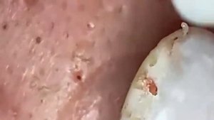 Выдавливание чёрных точек