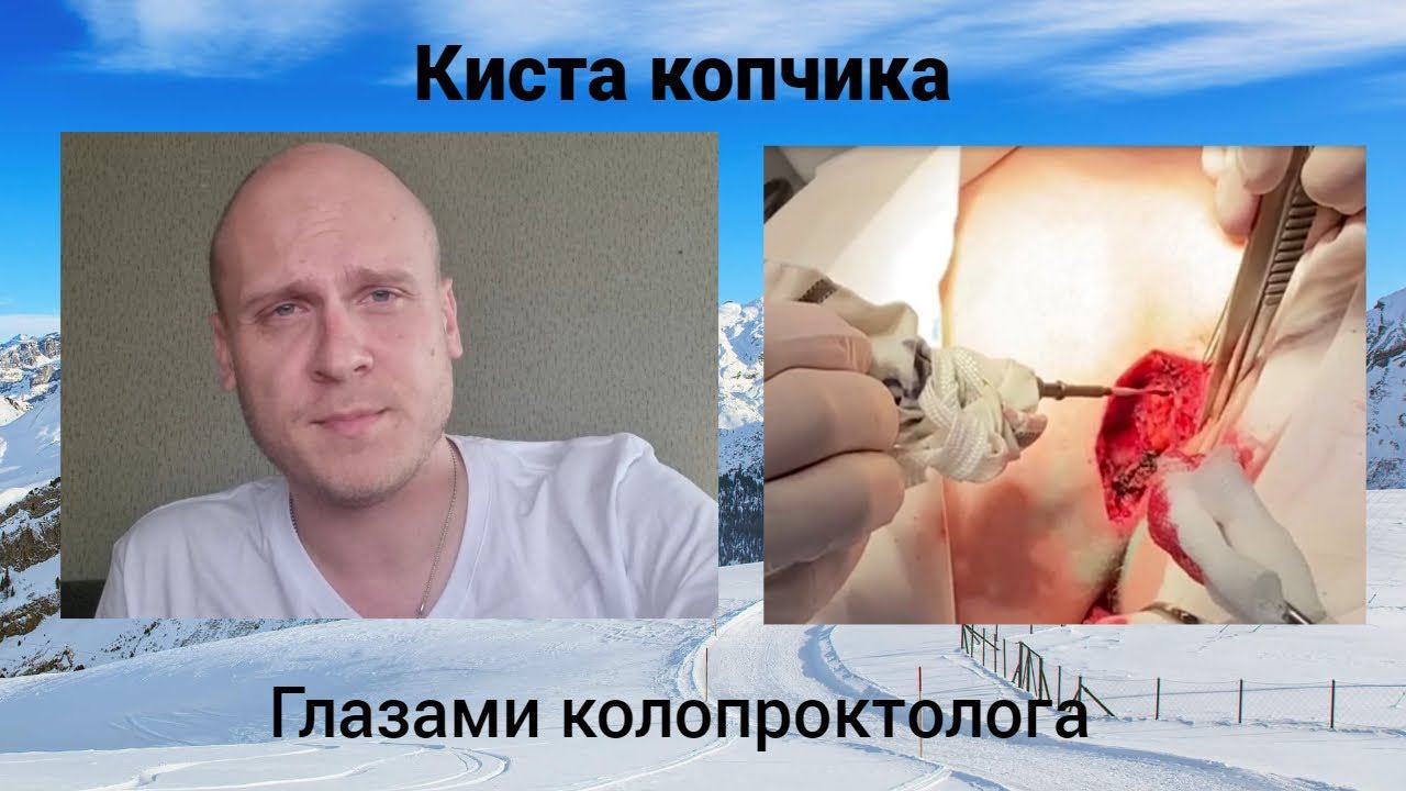 Киста копчика. Глазами колопроктолога.