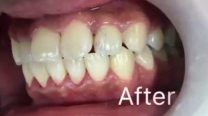 Как отбеливать зубы? Секреты стоматологов.