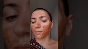 Лазерная шлифовка лица