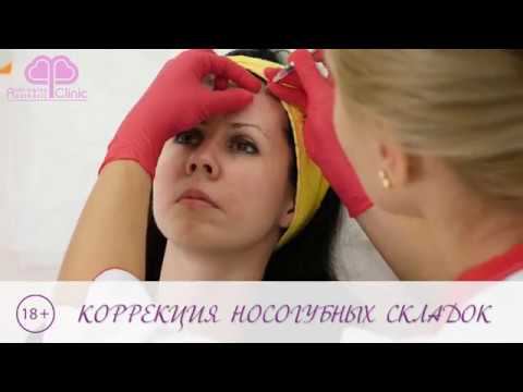 Коррекция носогубных складок филлером Рестилайн
