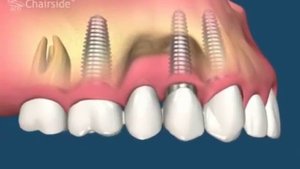 какие бывают ошибки при протезировании зубов