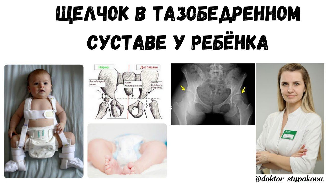 Щелчок в тазобедренном суставе при отведение ног у детей. Норма или патология.К кому обратиться? смотреть онлайн