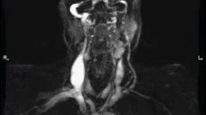 Контрастная МР ангиграфия сосудов шеи динамика пассажа контраста