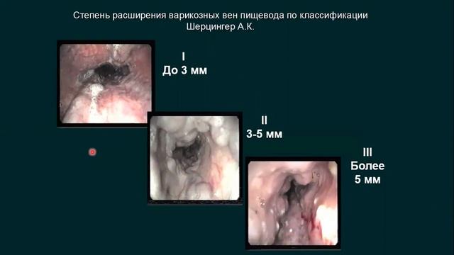 Портальная гипертензия
