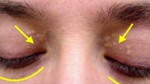Жировики на веках глаз! Причины появления жировиков на веках и как от них избавиться!