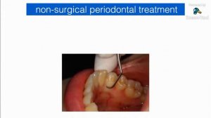 IADS Virtual Webinar : How to Treat Endo-Perio Lessions