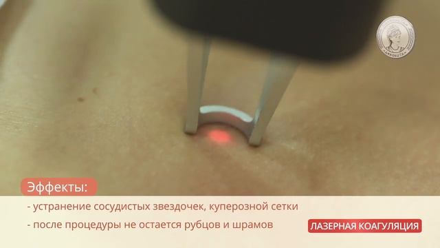 Лазерная коагуляция сосудов