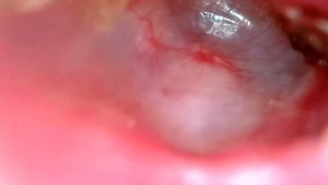 #тимпанопластика #оссикулопластика через 2 месяца после тимпанопластики с оссикулопластикой 🙂