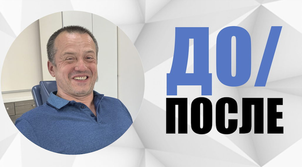 #7 Случай до/после. Лактионов Алексей - восстановление бокового резца: одномоментная имплантация.