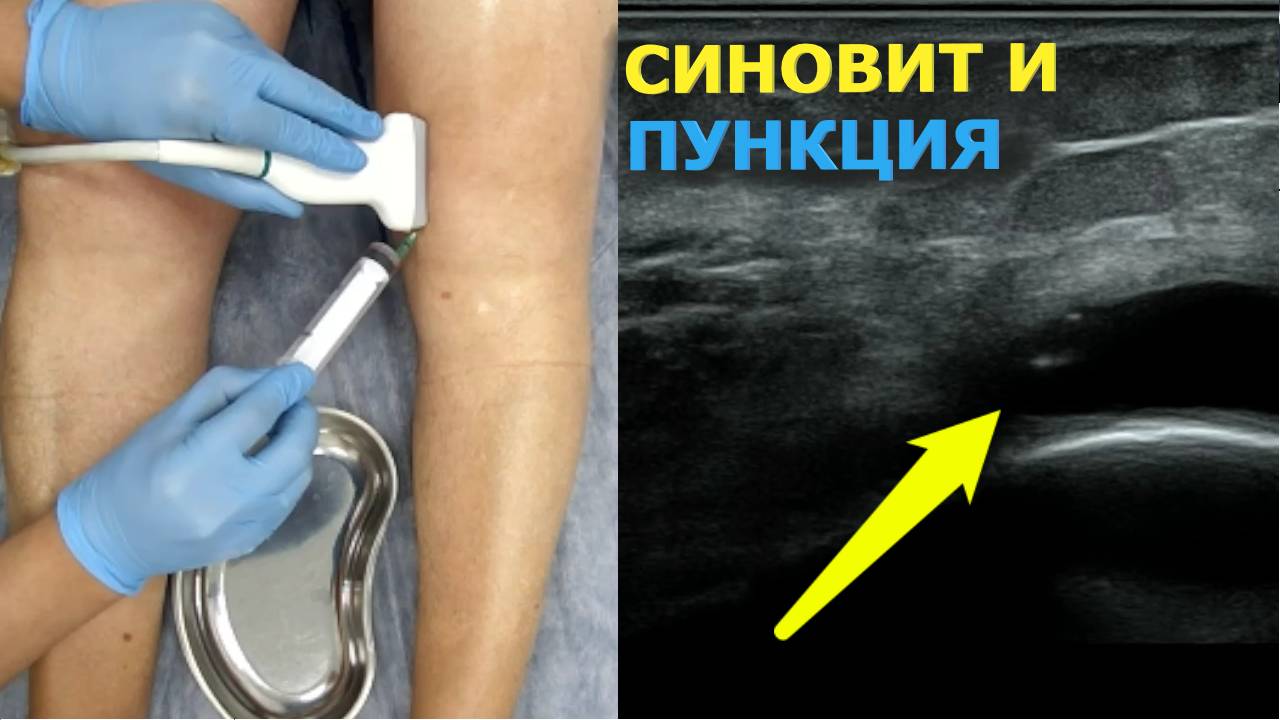 Пункция коленного сустава с УЗИ смотреть онлайн