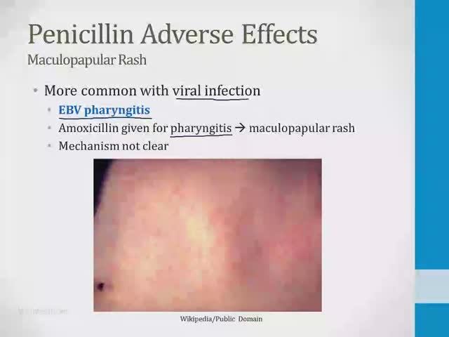 Инфекционные заболевания USMLE - 3. Антибиотики - 1.Пенициллины (Boards and Beyond)