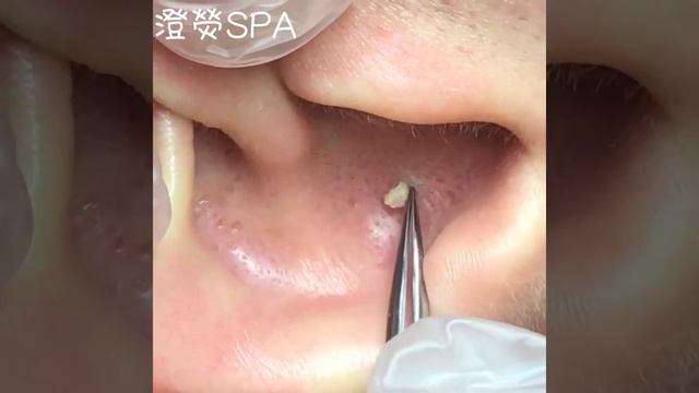 Гной в ухе смотреть онлайн