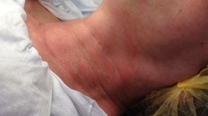 Меди лайт Филлеры заполнение морщин область шеи