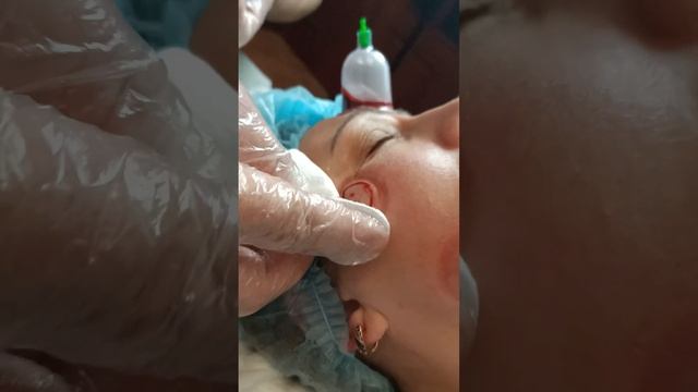 Косметическая Хиджама, постановка вакуумных банок на лицо. Омолаживает, устраняет морщины. #shorts