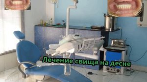 Лечение свища на десне
