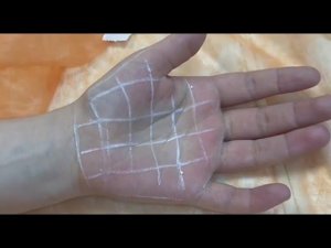 Гипергидроз ладоней. Уколы от потливости.